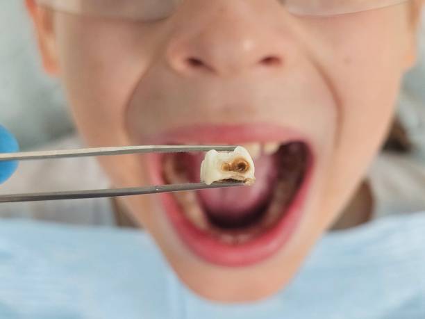 Best Knocked-Out Tooth Emergency  in Cienegas Terrace, TX